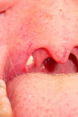 tonsil stones written by ullahshy